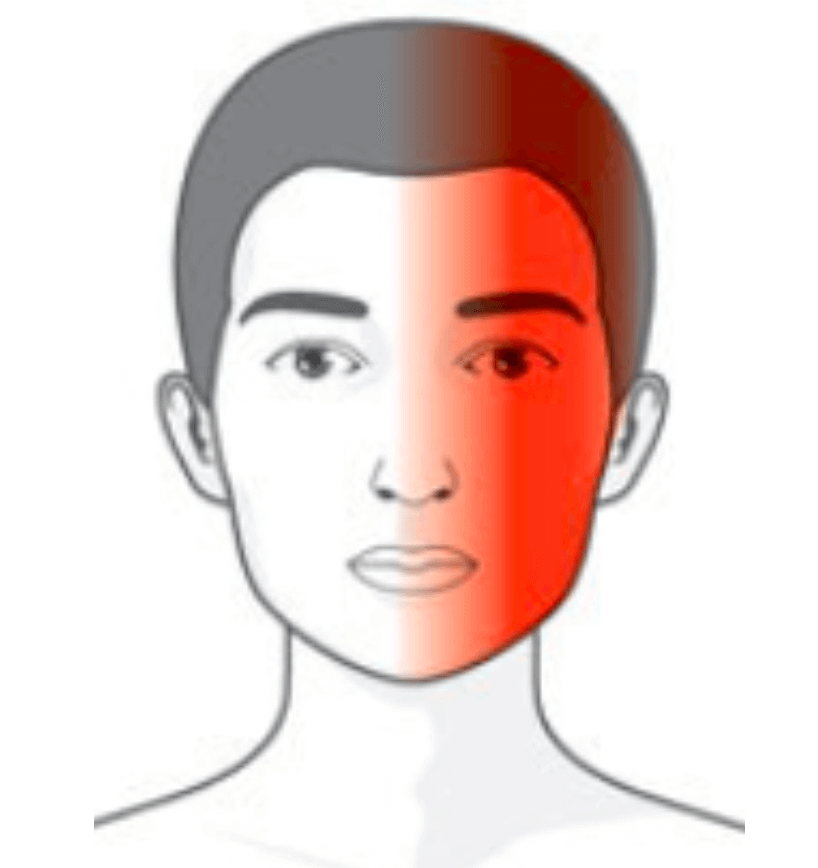 Localisation des algies de la face