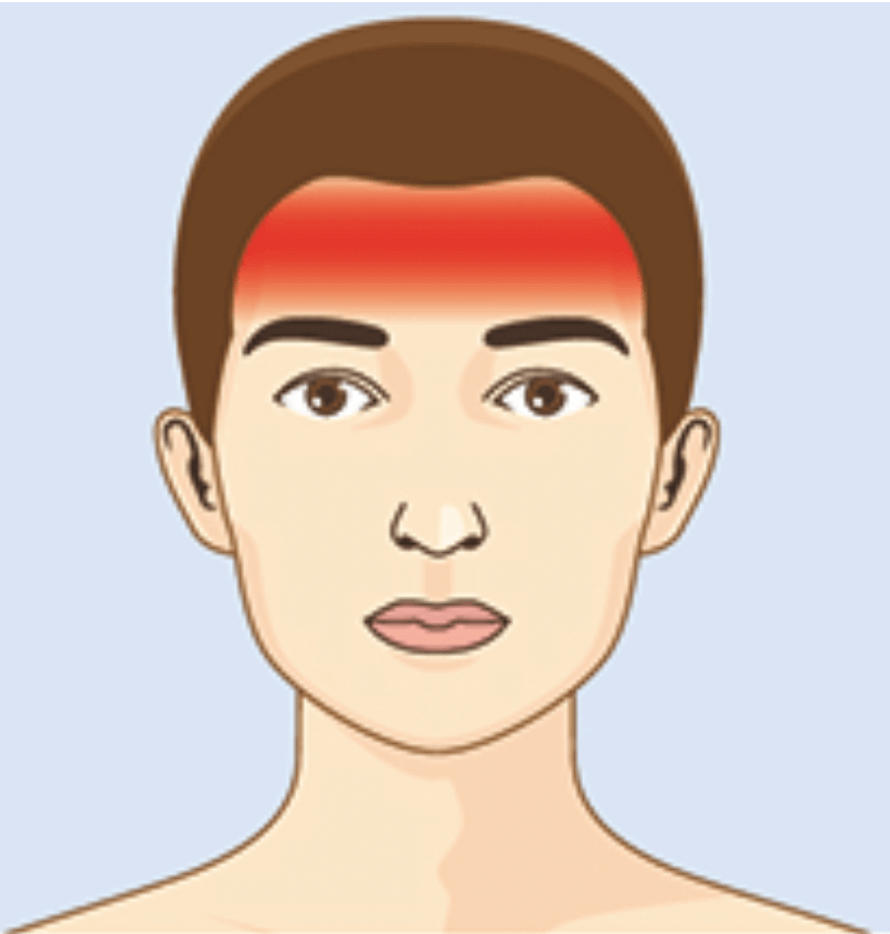 Localisation de la céphalée de tension