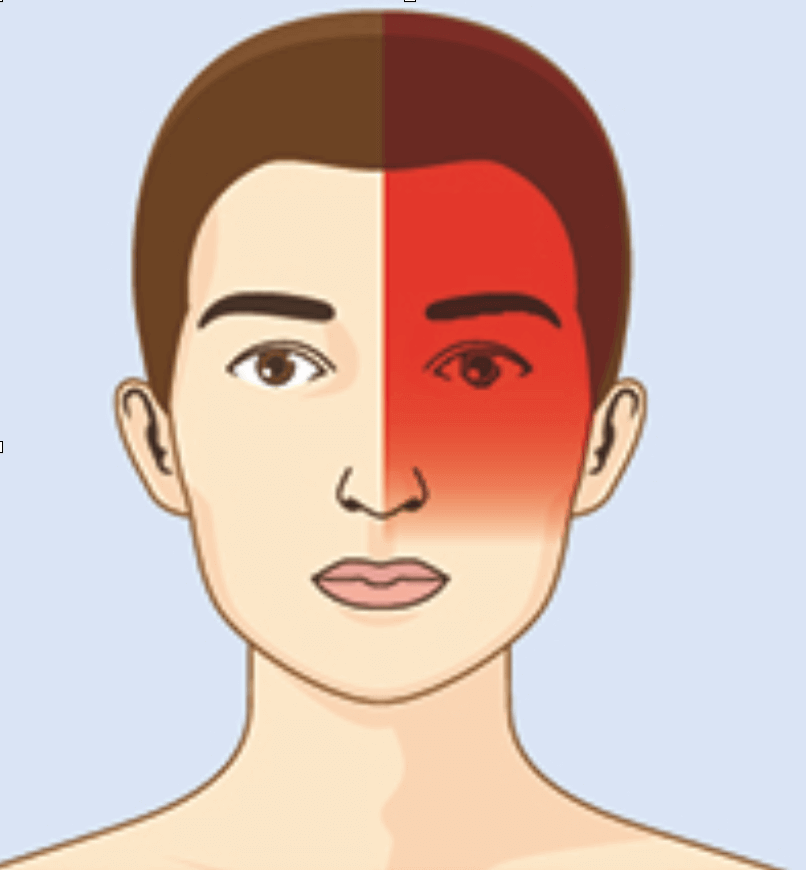 Localisation de la migraine