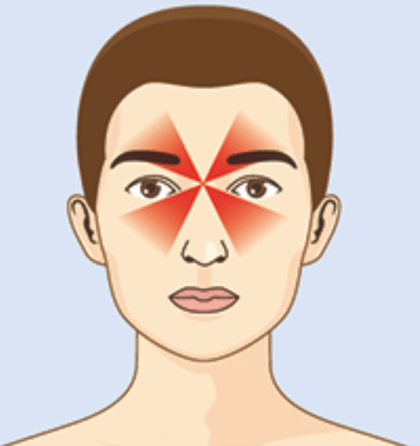 Localisation de la sinusite